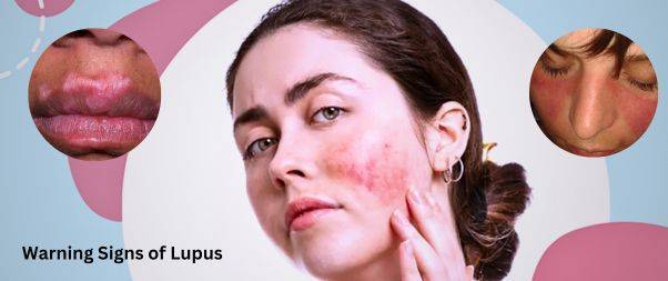 Warning Signs of Lupus