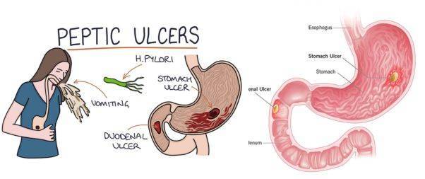 What are Peptic Ulcers?