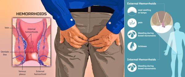 What are Hemorrhoids?