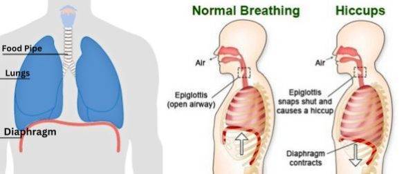 What Causes Hiccups in Cancer Patients